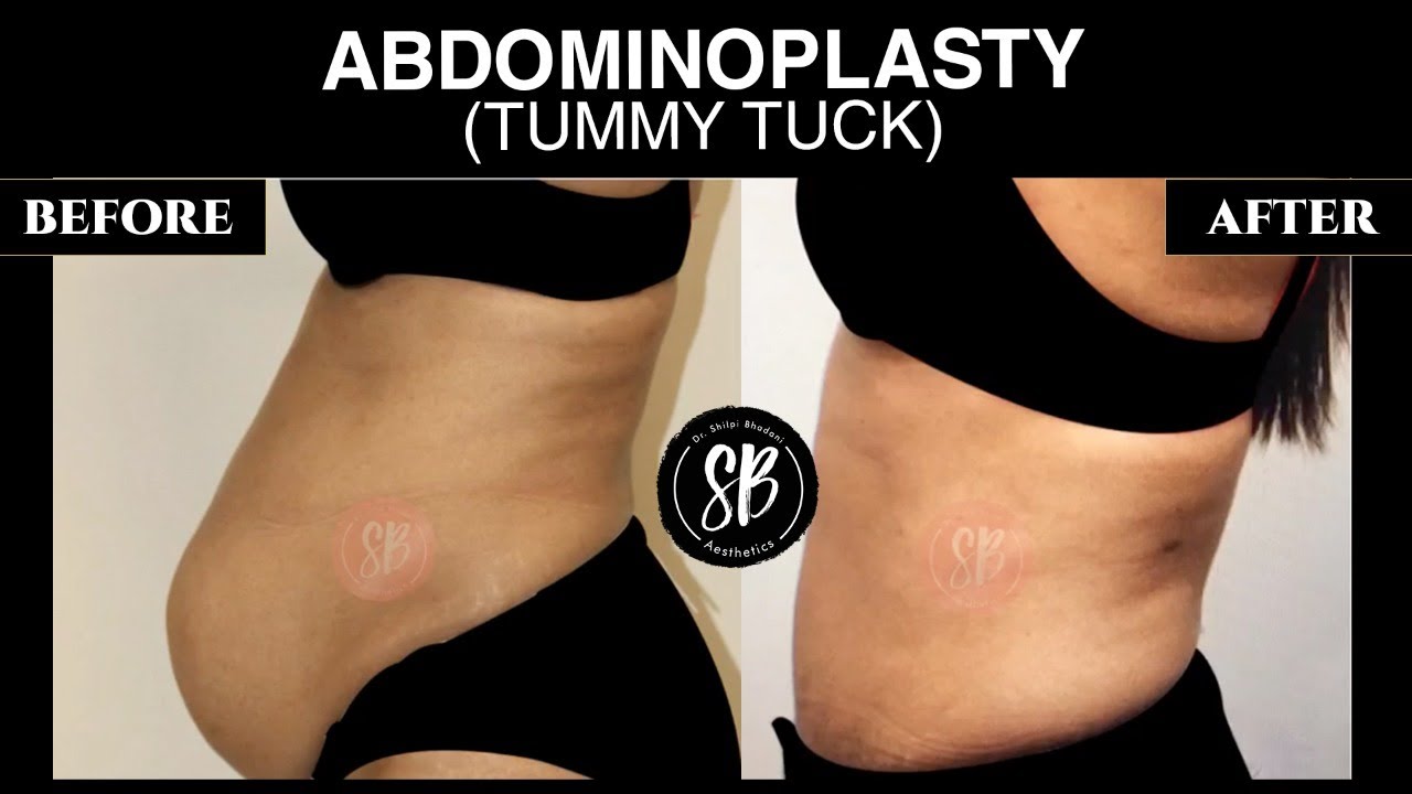 Tummy Tuck Surgery (Abdominoplasty) Before and After | Dr. Shilpi Bhadani