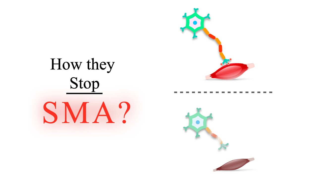 Two strategies for treatment of spinal muscular atrophy (SMA) I Crucial details