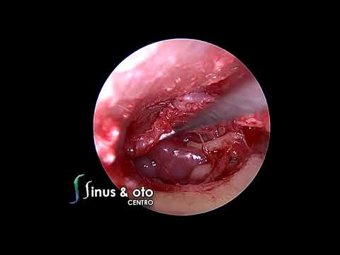 Tympanic Glomus - Endoscopic Ear Surgery