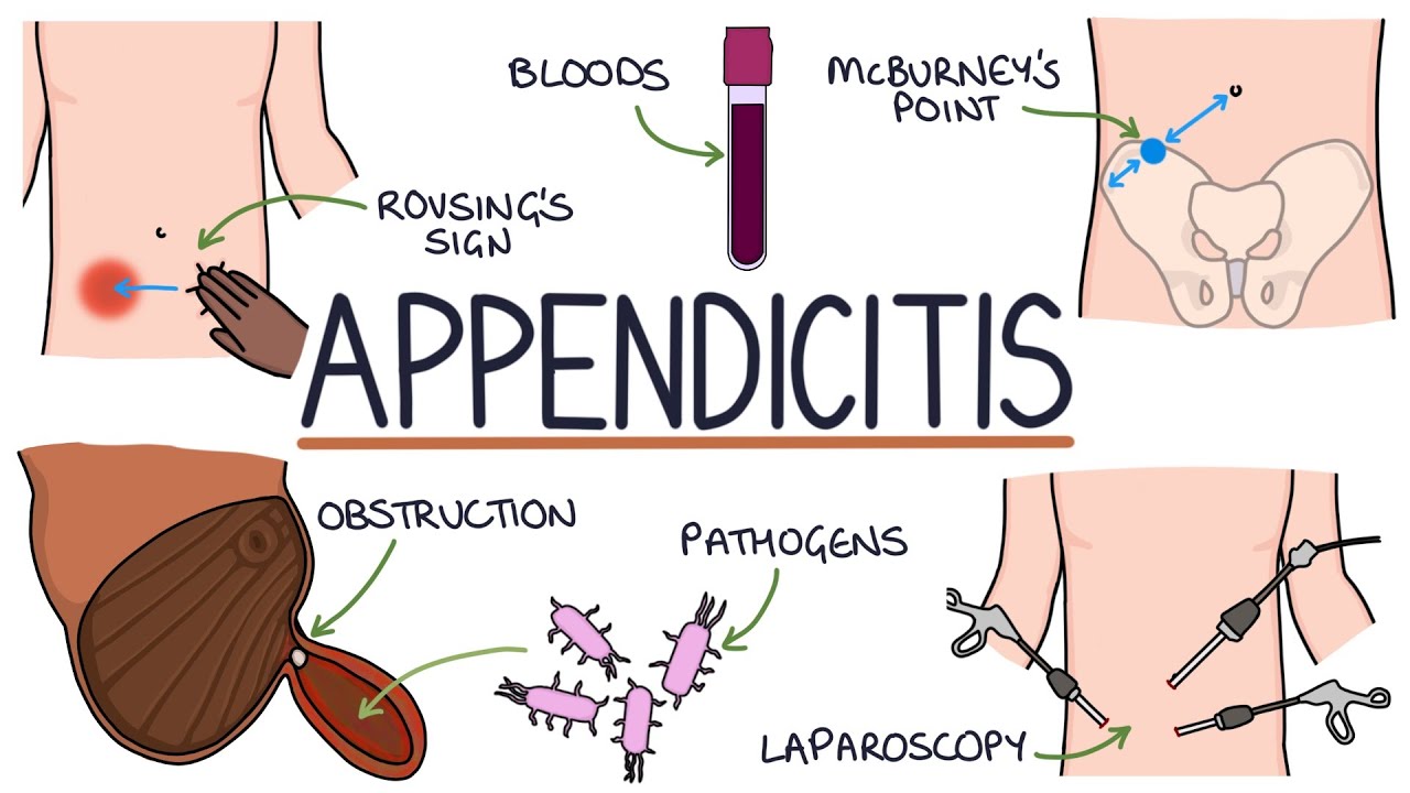 Understanding Appendicitis