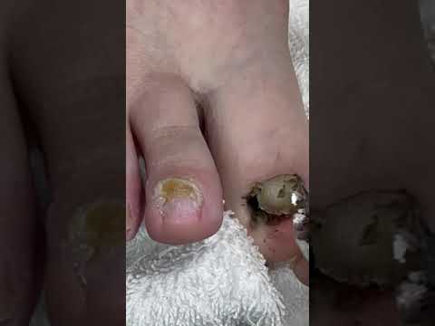 Upcoming Toenail Transformation, Subscribe to Join my Community