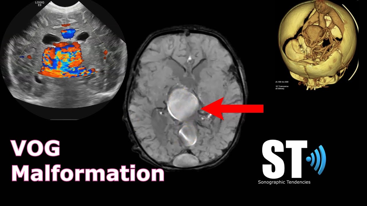 Vein of Galen Malformation (Aneurysm)