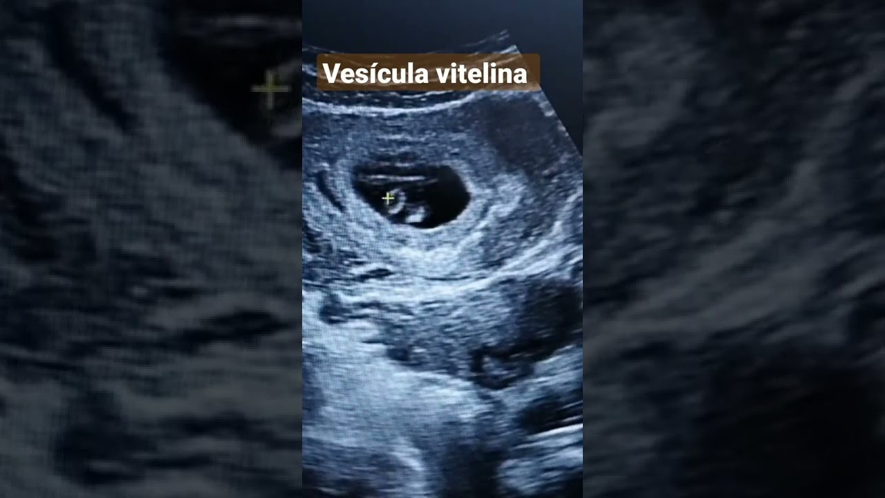 VESÍCULA VITELINA 6 SEMANAS DE GESTACIÓN