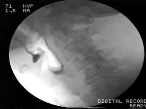 Video 2 - Videofluoroscopic example of cricopharyngeal bar