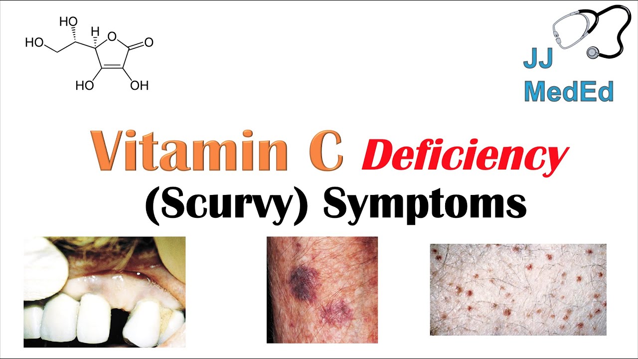 Vitamin C Deficiency (Scurvy) Symptoms (ex. bad teeth, fatigue), Why symptoms happen & who gets them