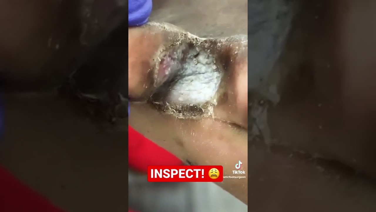 WAIT FOR IT! 🤯#shorts #fungus #feet #dermatology #podiatry