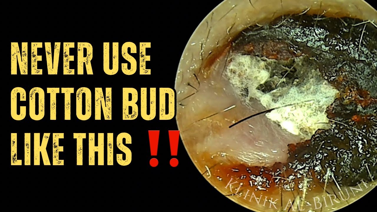 WARNING : Never Use Cotton Bud Like This‼️