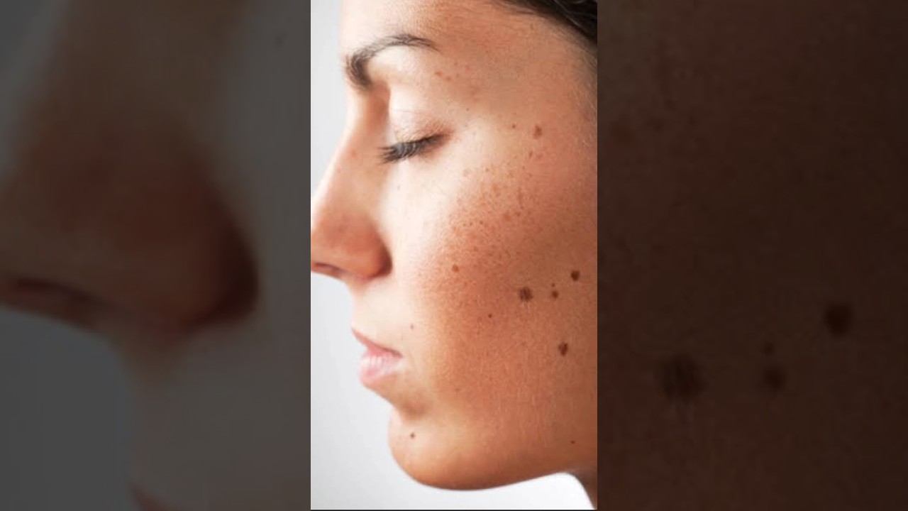 Warning! How to Safely Remove Moles from Your Face #shorts #til #facemoles