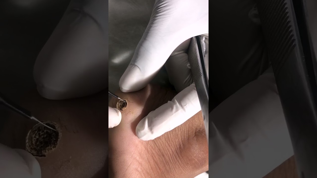 Warts Removal Treatment | Safe and Effective Wart Removal Treatment | Skinaa Clinic #viral #ytshorts