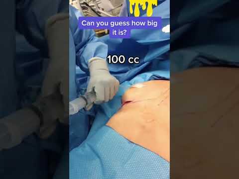 Watch an implant deflate! #shorts