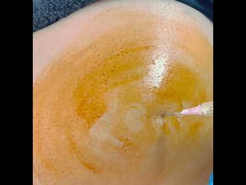 Watch an Injection of PRP into the Hip