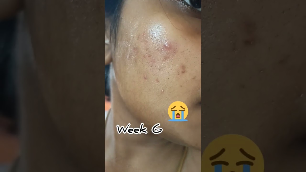 😭Watch before buying 10% Niacinamide serum testing for 6 weeks #shorts