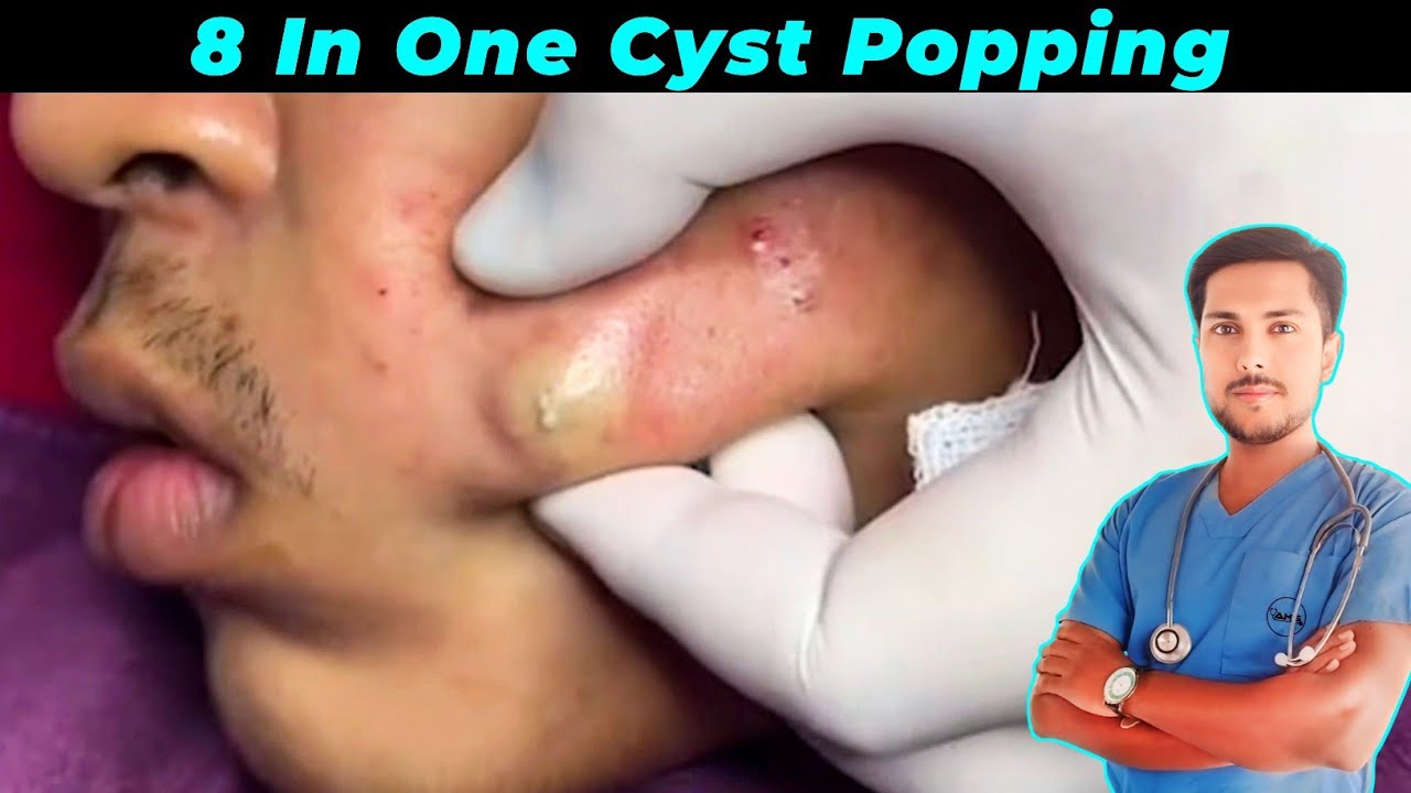 Watch These Top 8 Satisfying Cyst Popping Clips | Safe & Painless Pimple Popping & Cyst Extraction.