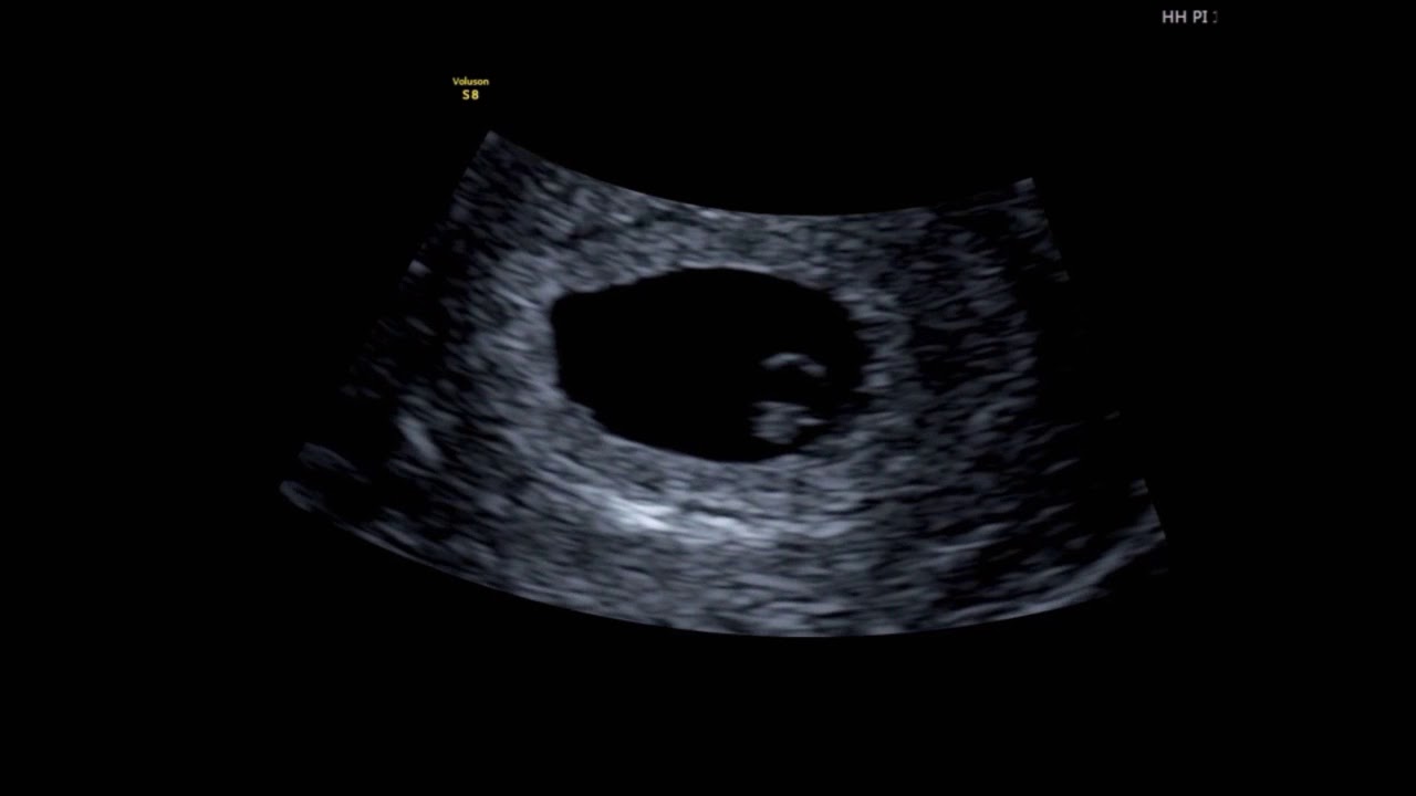 What Can You See At A 6 Week Baby Scan?