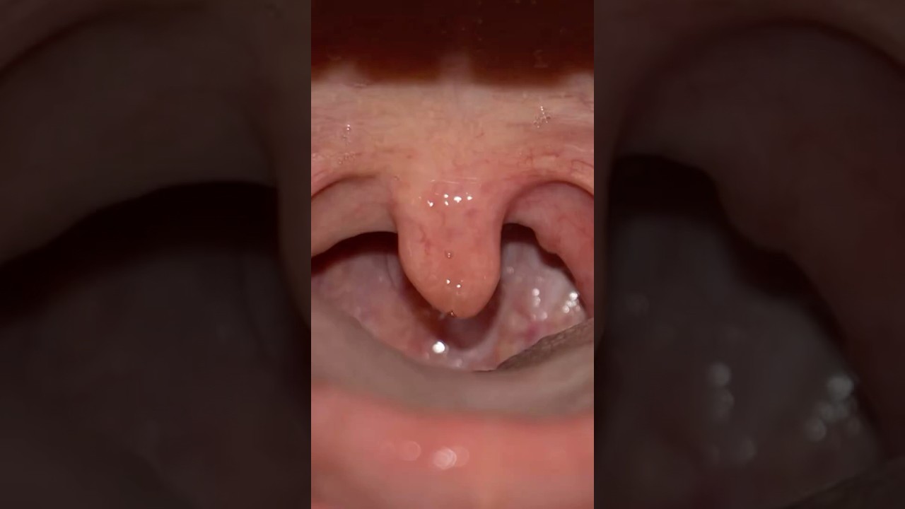 What causes a crooked Uvula? #uvula