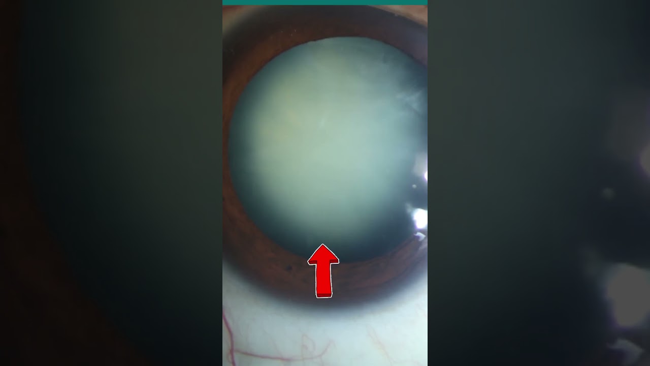 What Does a Cataract Look Like Inside Your Eye? (Visual Representation)