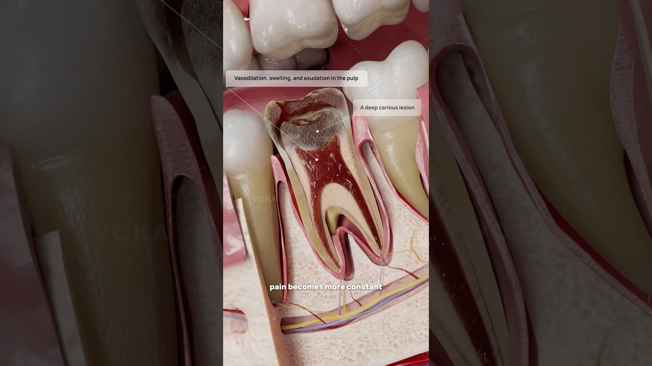 What is acute pulpitis and how does it affect tooth health? 🦷 3D animation