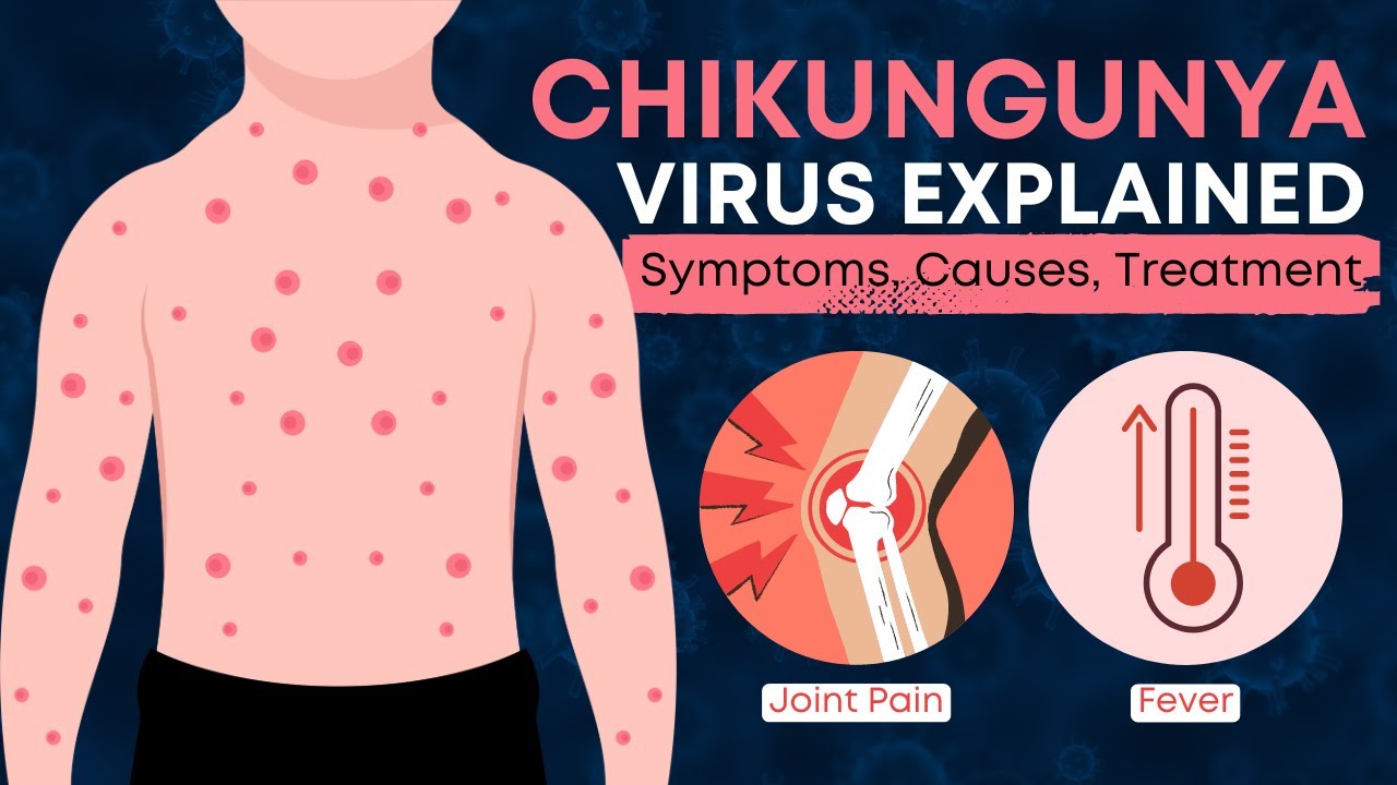 What is Chikungunya Virus? | All You Need to Know About Chikungunya Virus