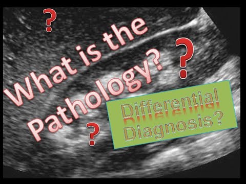 What is the pathology? #ultrasound #nephrocalcinosis