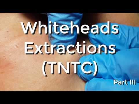 Whiteheads Extraction (TNTC) - Session I - Part 3 of 3
