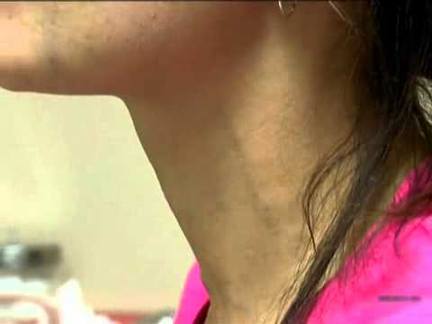 Woman's Abnormal Neck Pulses Caused By Heart Condition | Video