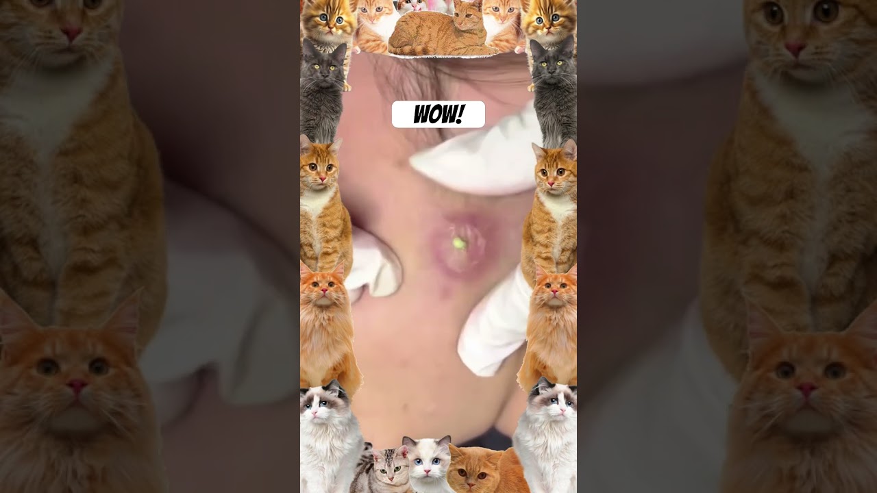 Wow! #ytshorts #pimplepopper #blackheadremoval #pimplepopping #pimpleextraction #youtube #pimple