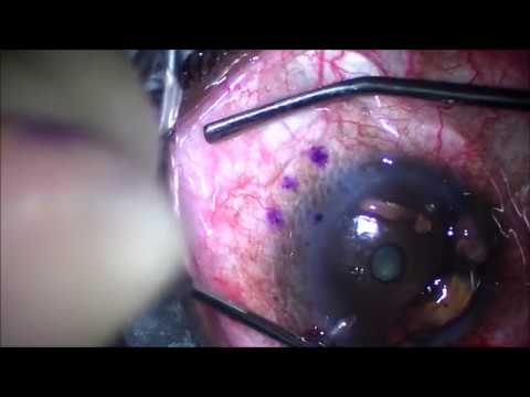Xen Gel Implant for Glaucoma. Allergan. Edited. J.T. Kavanagh MD. San Antonio.