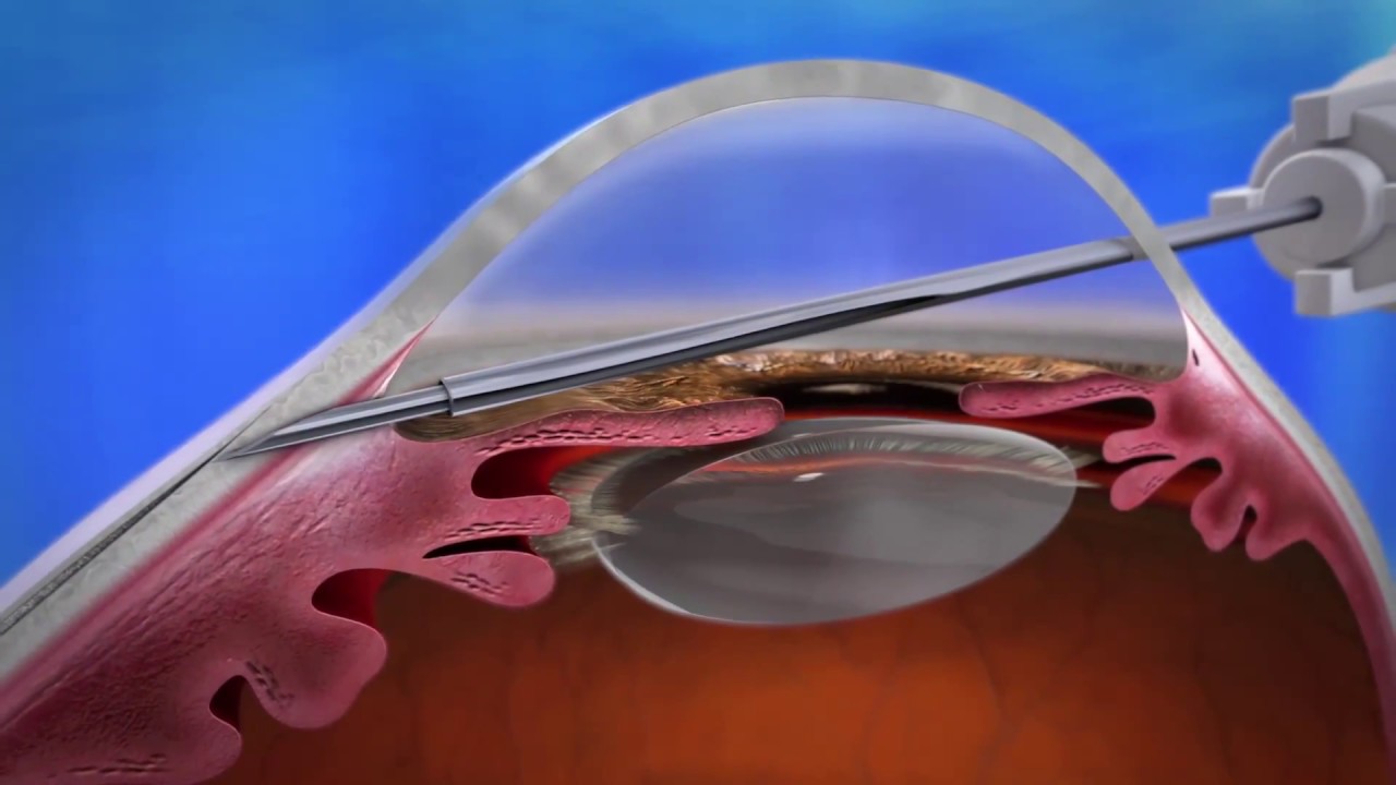 Xen Gel Stent