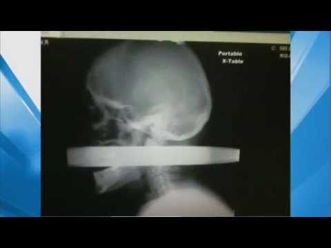 X-Ray: Man Impaled by Pipe in Head Survives