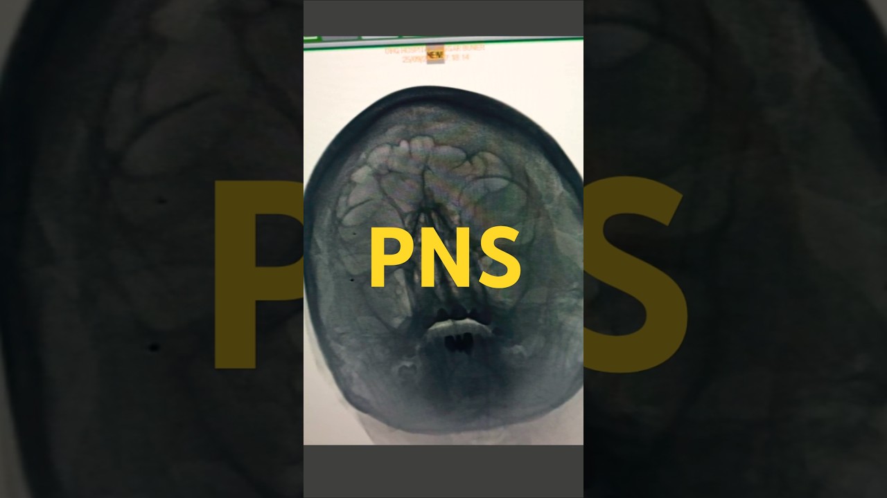 Xray PNS sinusitis #anatomy #xraytechnician #humananatomy #radiologycareer #doctor #xray #humanbody
