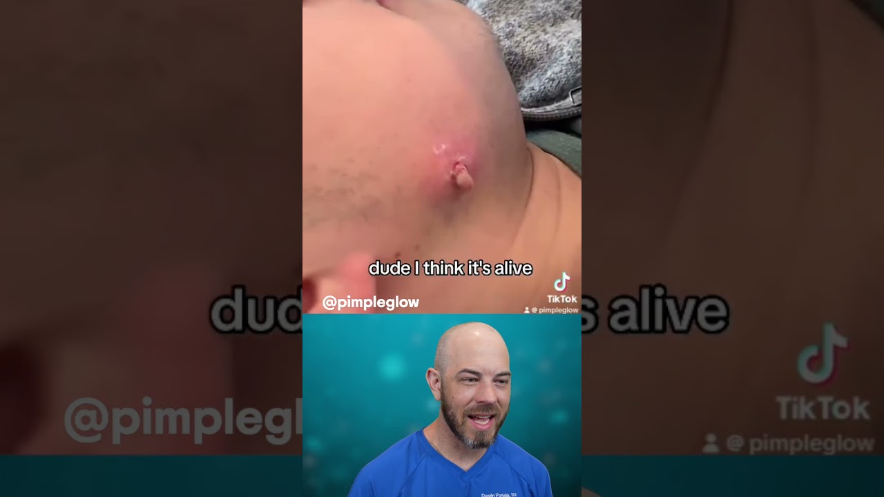 You've GOT to see this super infected cyst removal🫣 (credit: @pimpleglow on TT) #cyst #s#satisfying